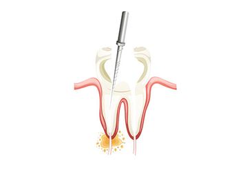 Dantų šaknų kanalų gydymas