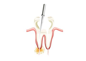 Dantų šaknų kanalų gydymas